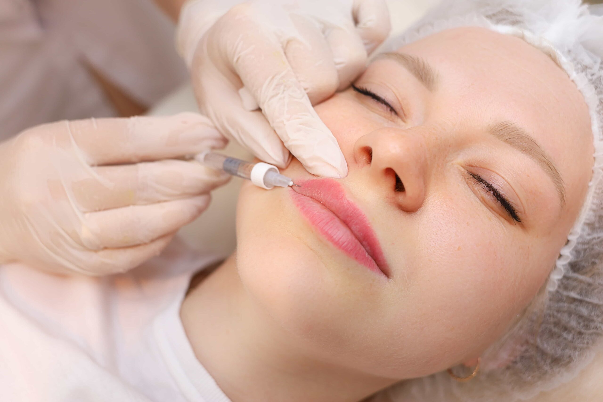 Close-up of a client receiving a lip filler injection into the upper lip, administered by a professional wearing white gloves.