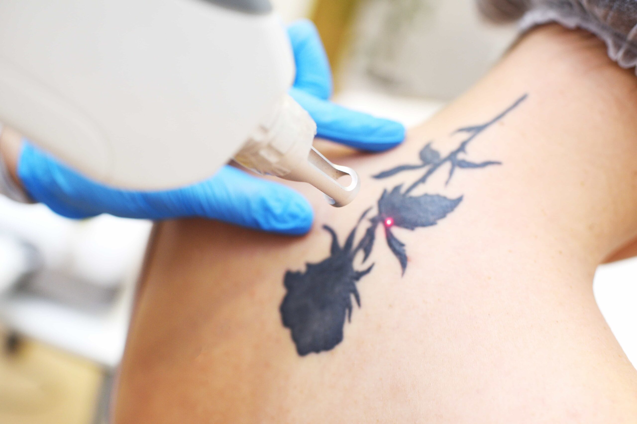 Close-up of a professional wearing blue gloves performing a laser tattoo removal procedure on a client's shoulder, targeting a large black rose design.