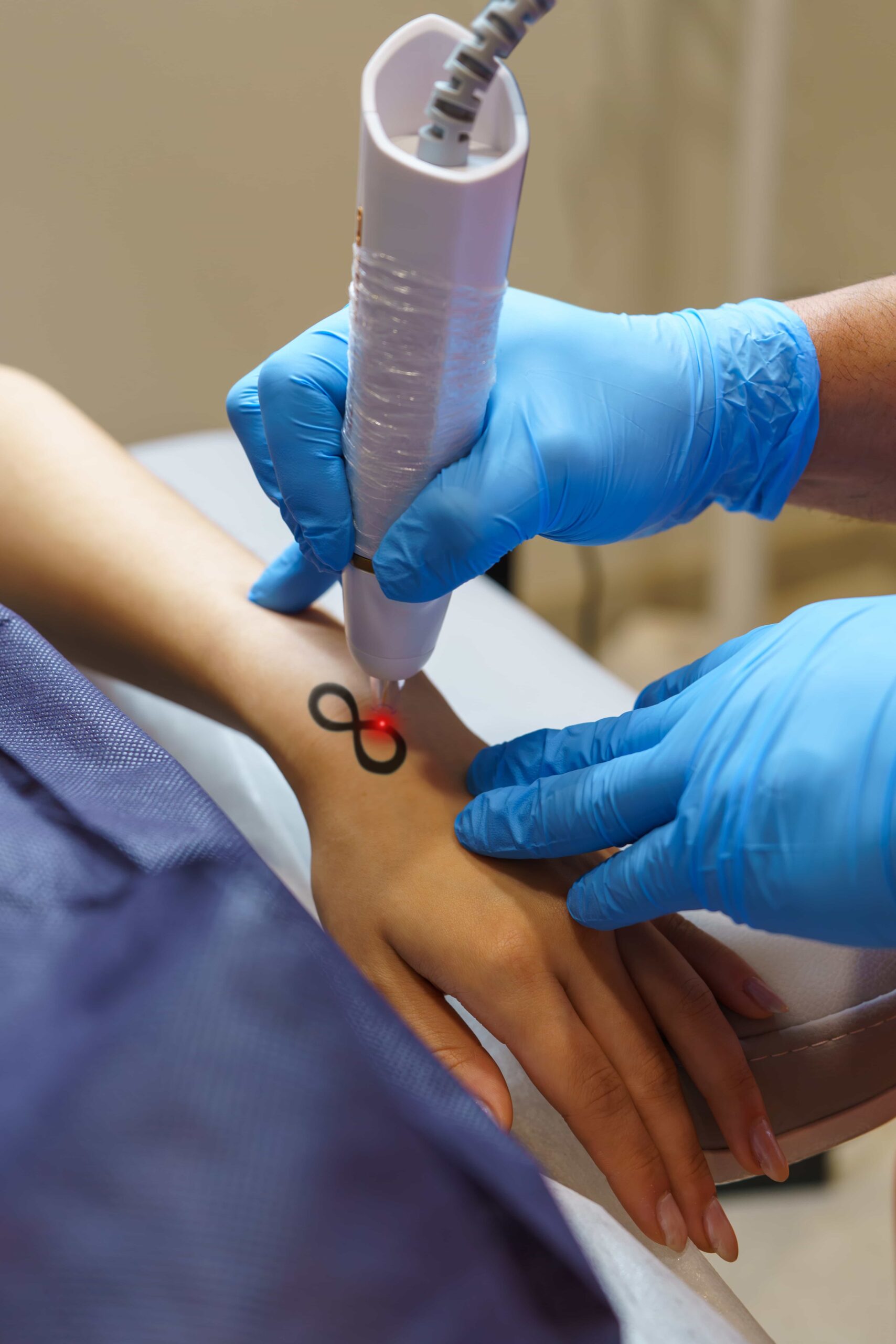 Close-up of a client receiving laser tattoo removal on a small infinity symbol tattoo on the back of their hand, administered by a professional wearing blue gloves.