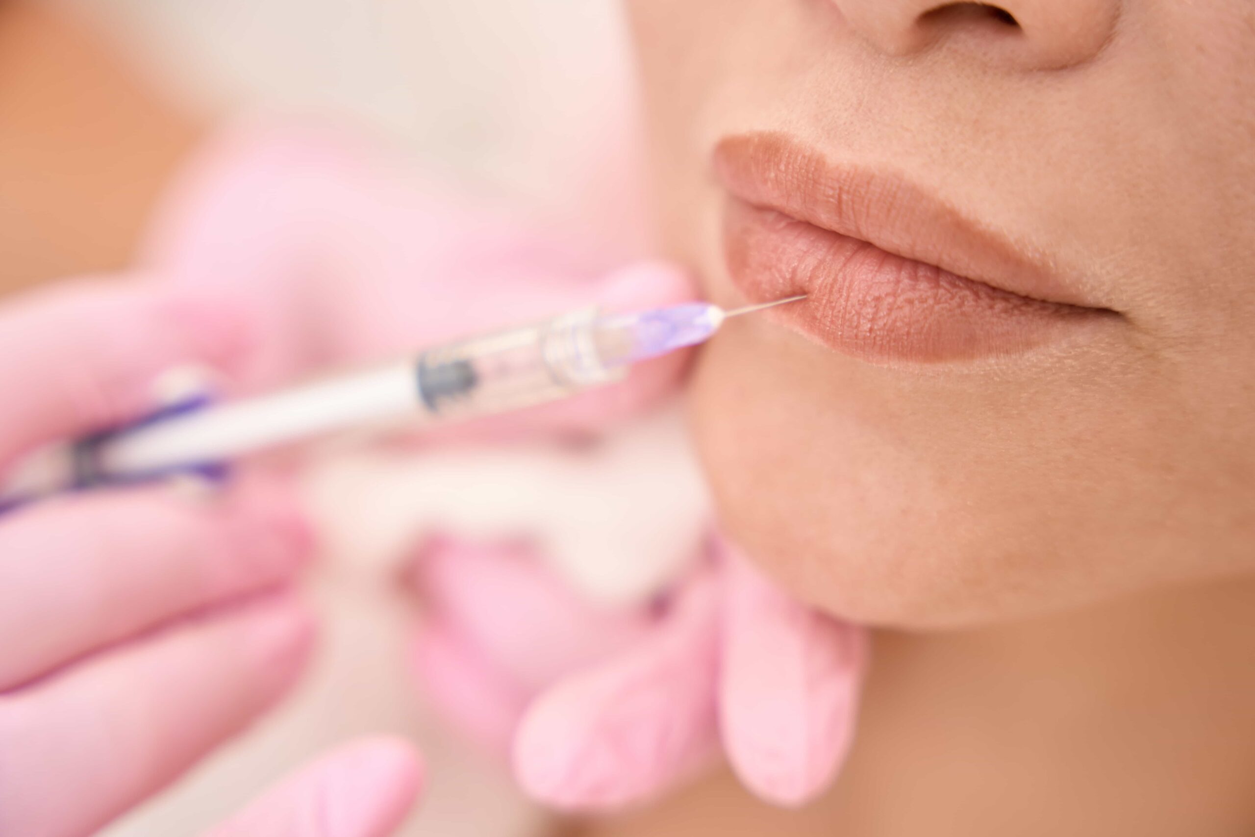 Close-up of a client receiving a precise dermal filler injection into the border of her upper lip, administered by a professional wearing pink gloves.
