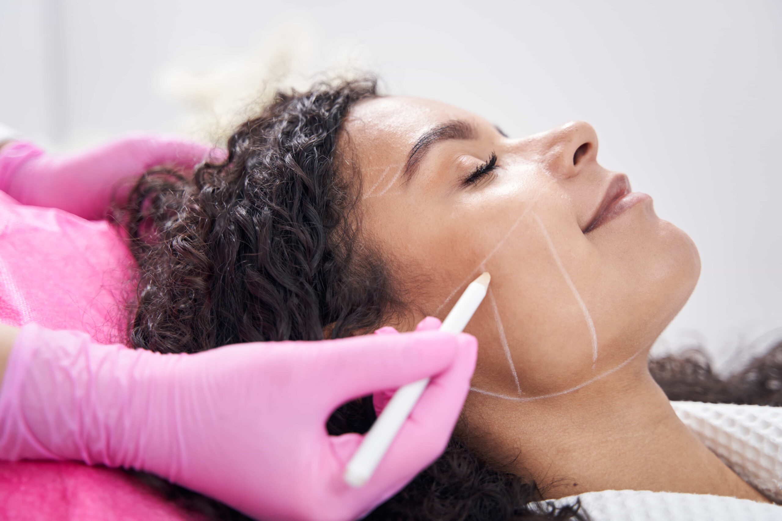 Side profile of a woman having her cheek and jawline marked with white lines by a professional in pink gloves, in preparation for a dermal filler or contouring procedure.