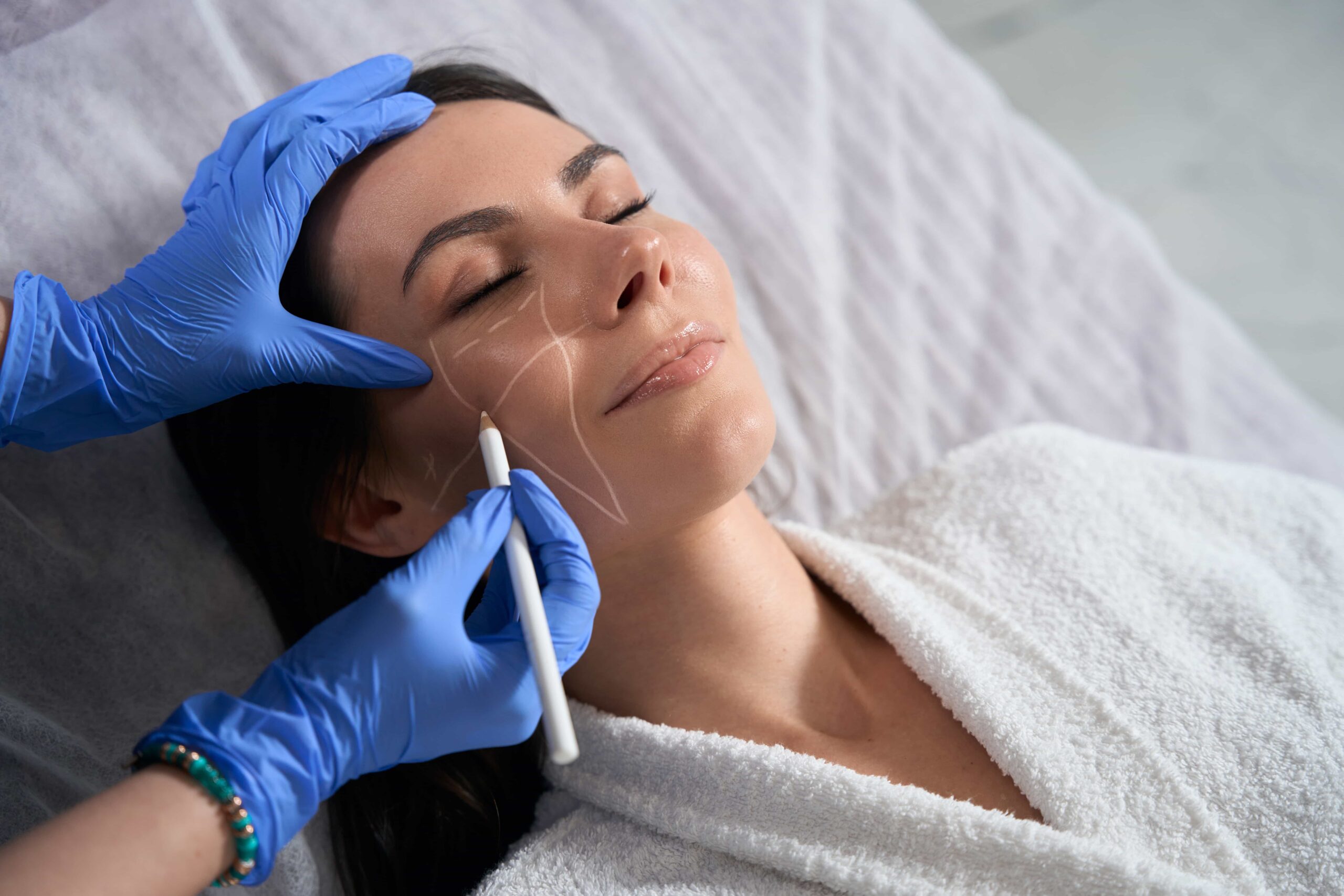 A professional in blue gloves marking a woman's face with white lines to map treatment areas for dermal fillers, threads, or facial contouring procedures.