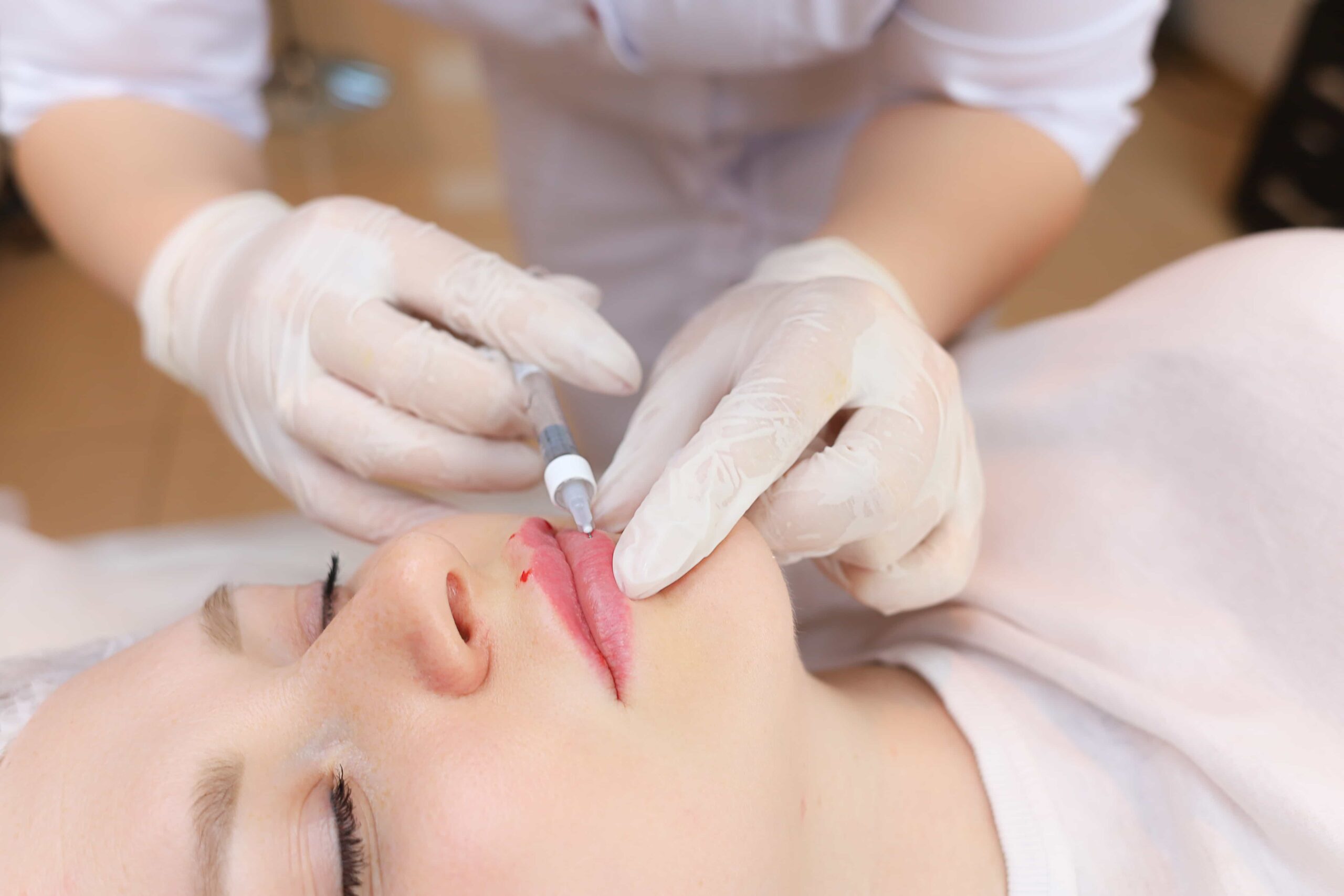 High-angle close-up of a client receiving a lip injection, with a professional in white gloves administering the dermal filler to the vermillion border.