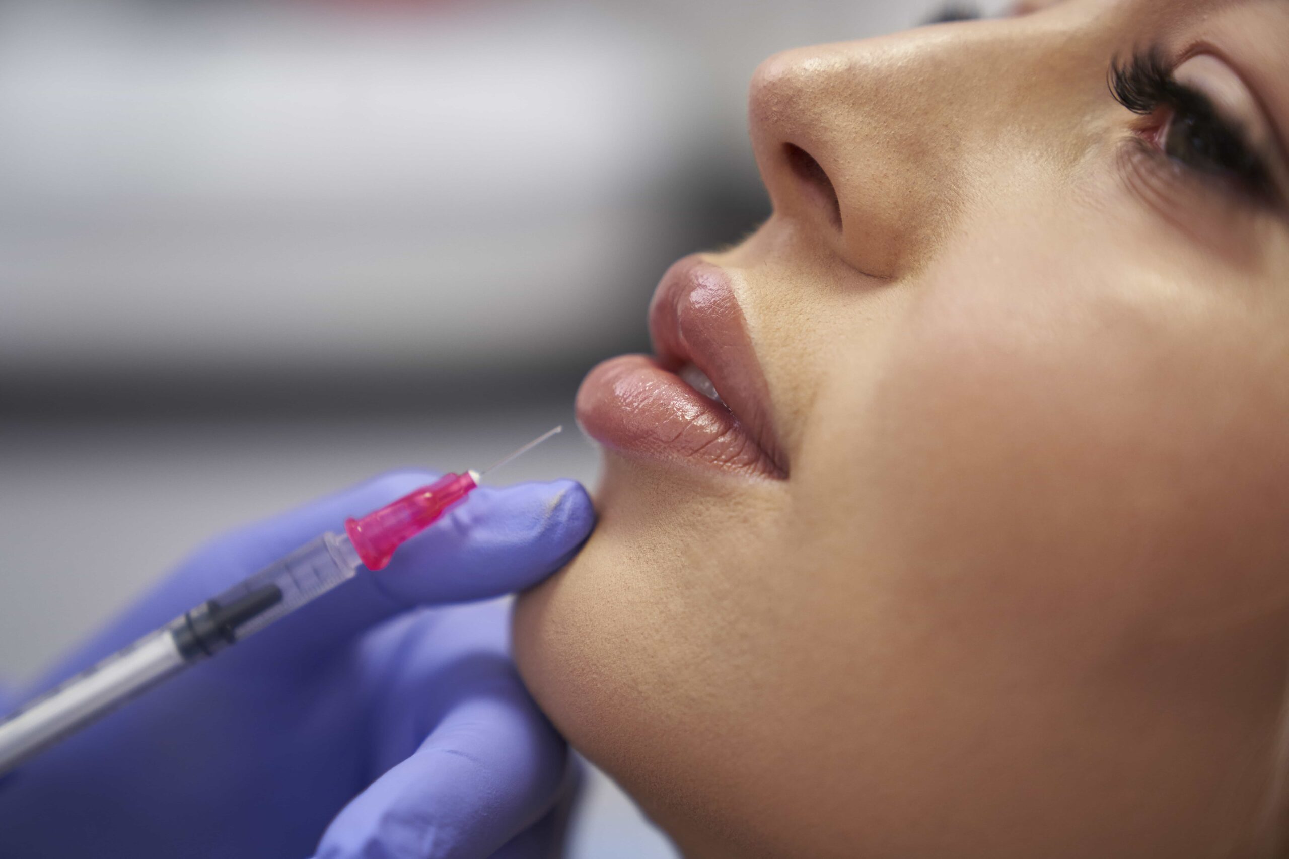 Extreme close-up of a professional wearing a blue glove administering a hyaluronic acid injection to a client's upper lip for cosmetic augmentation.