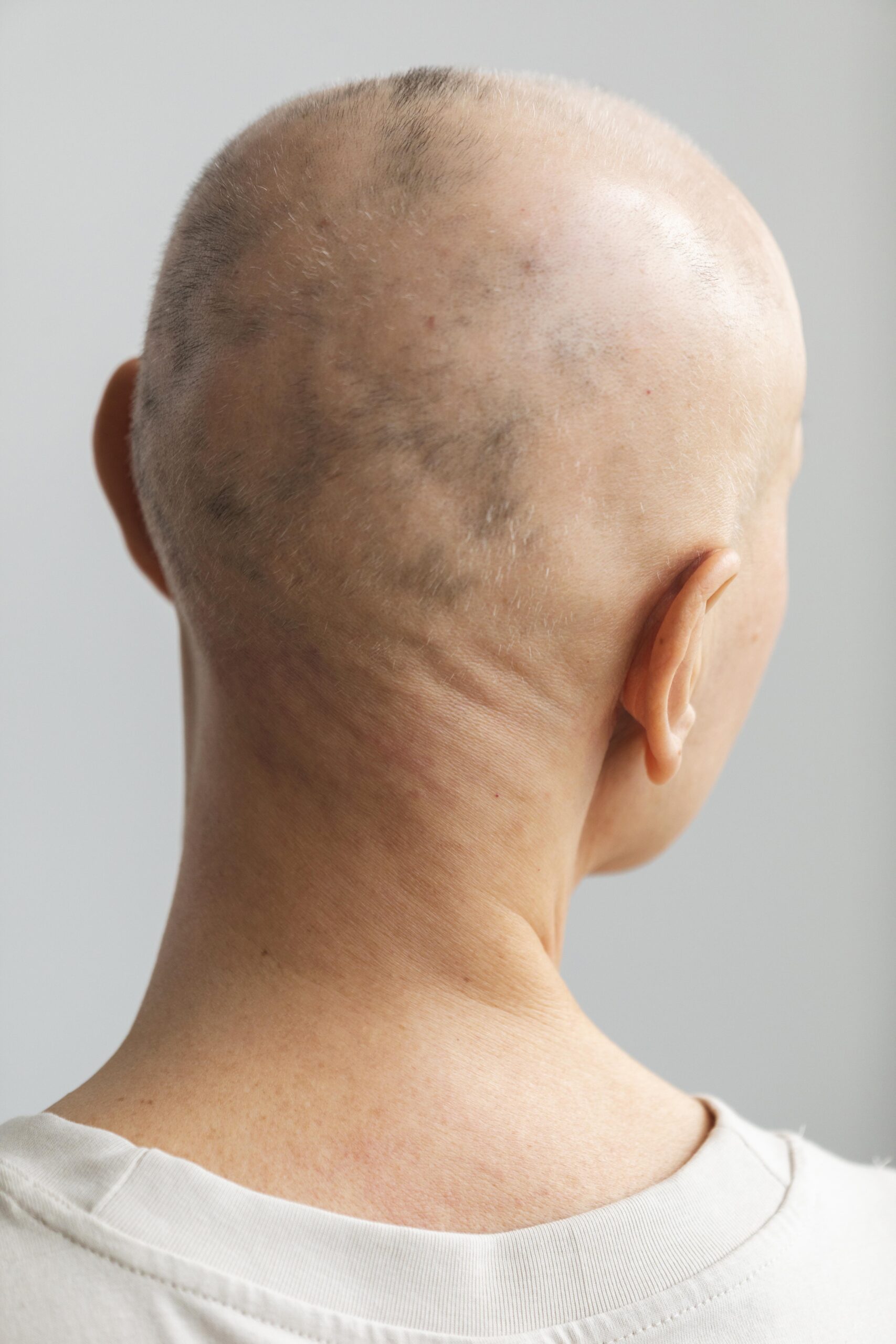 Rear view of a person's shaved head showing visible patches of hair loss or thinning, suitable for content about alopecia or hair restoration treatments.