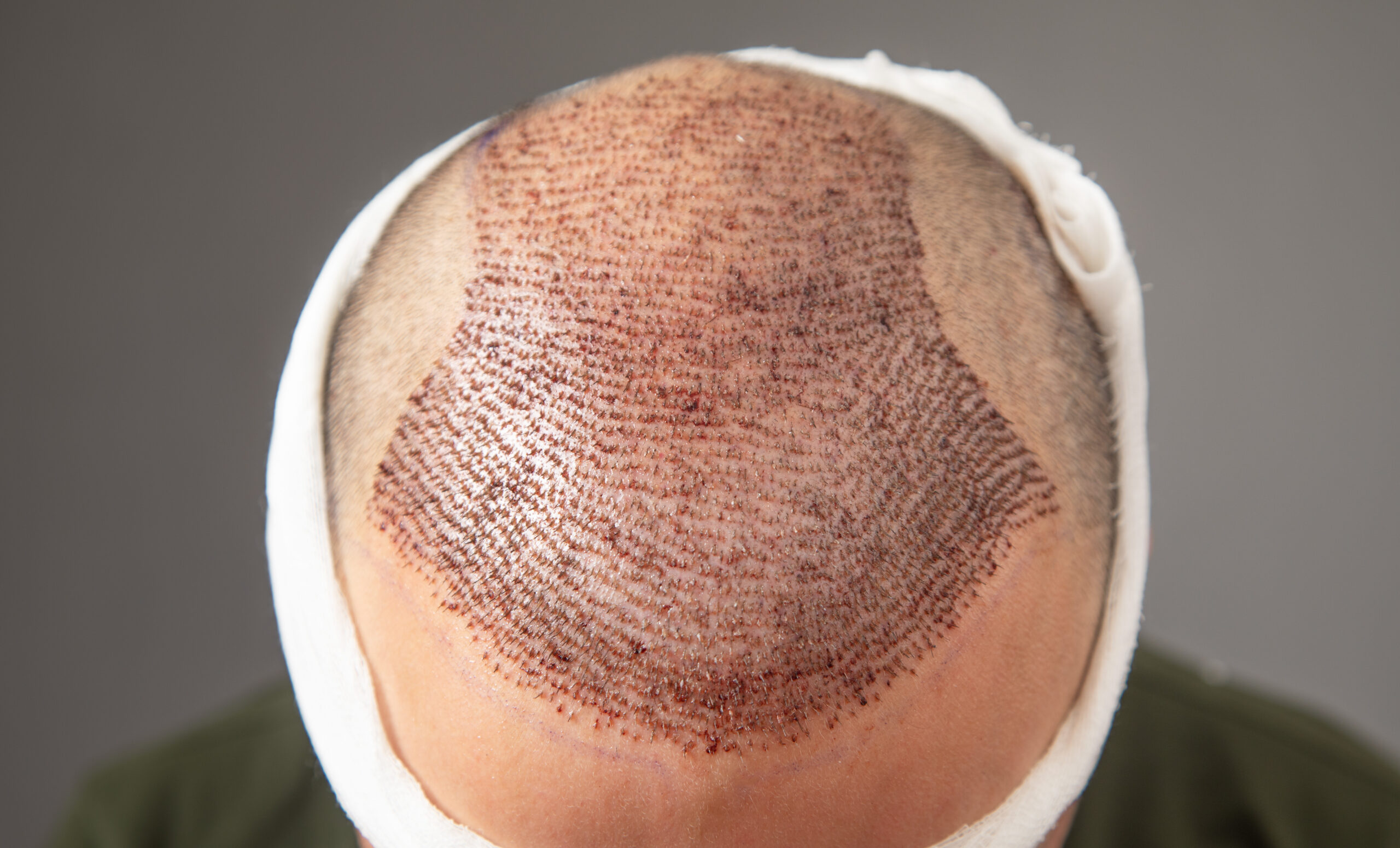 Top-down view of a scalp immediately following a hair transplant procedure, showing the dense pattern of newly implanted grafts (follicular units).