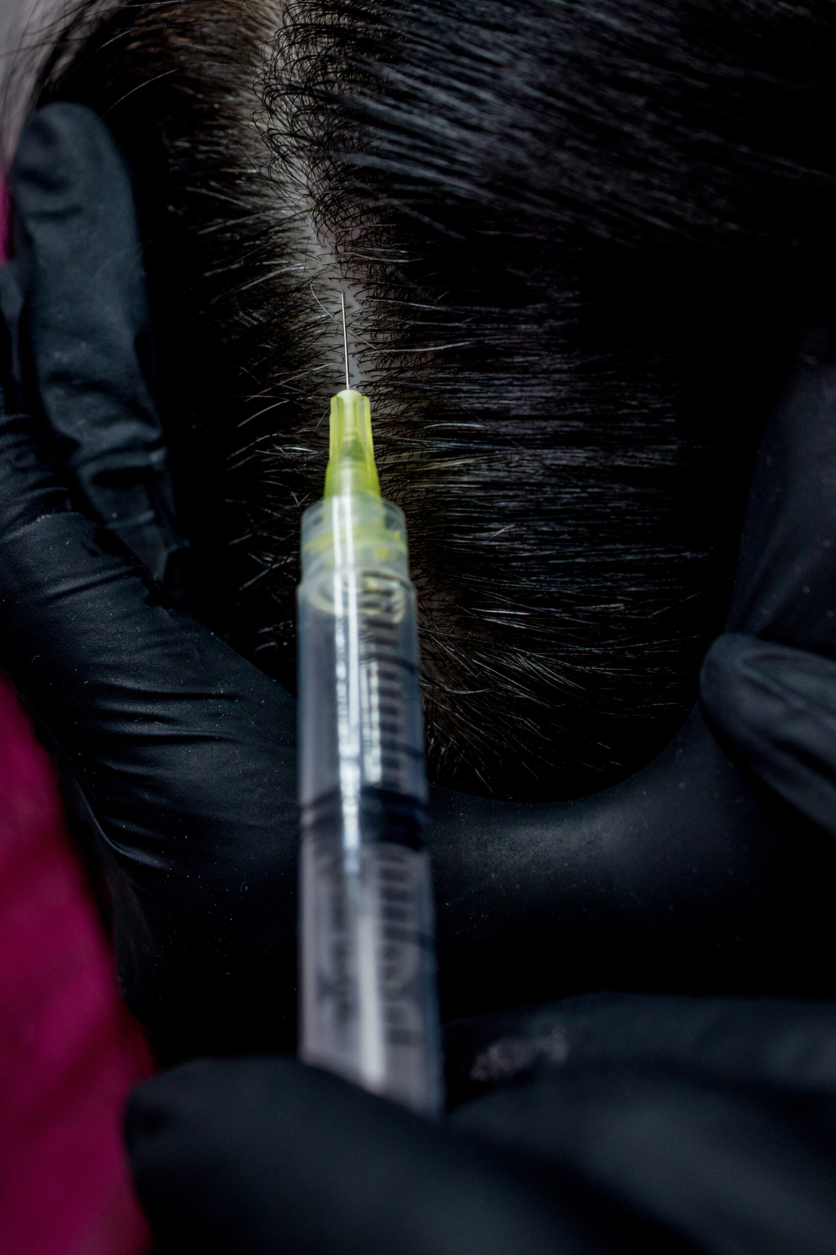 Extreme close-up of a professional in black gloves administering a hair restoration injection, such as PRP or Mesotherapy, directly into a client's scalp and hair parting.