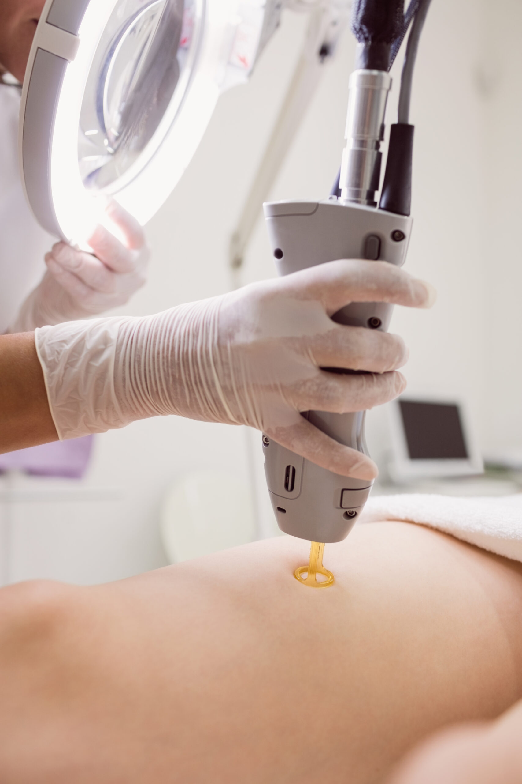 Woman having laser hair removal procedure performed on face