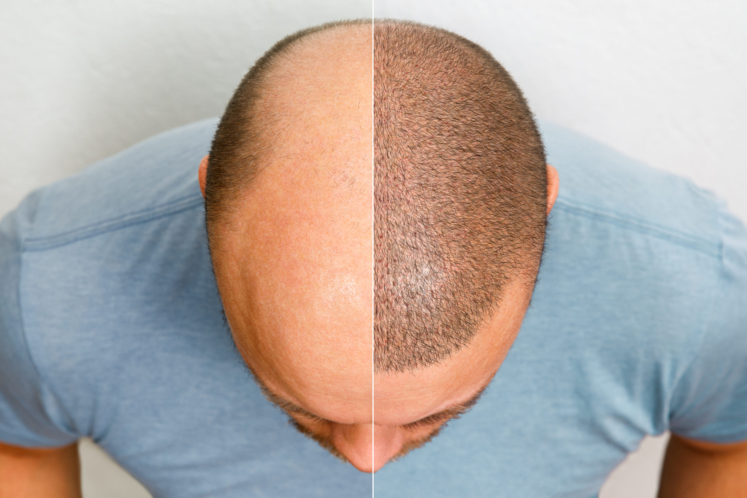 Top-down view of a man's head showing a before-and-after split image, with the left side showing baldness and the right side showing the look of full hair coverage created by scalp micropigmentation (SMP).