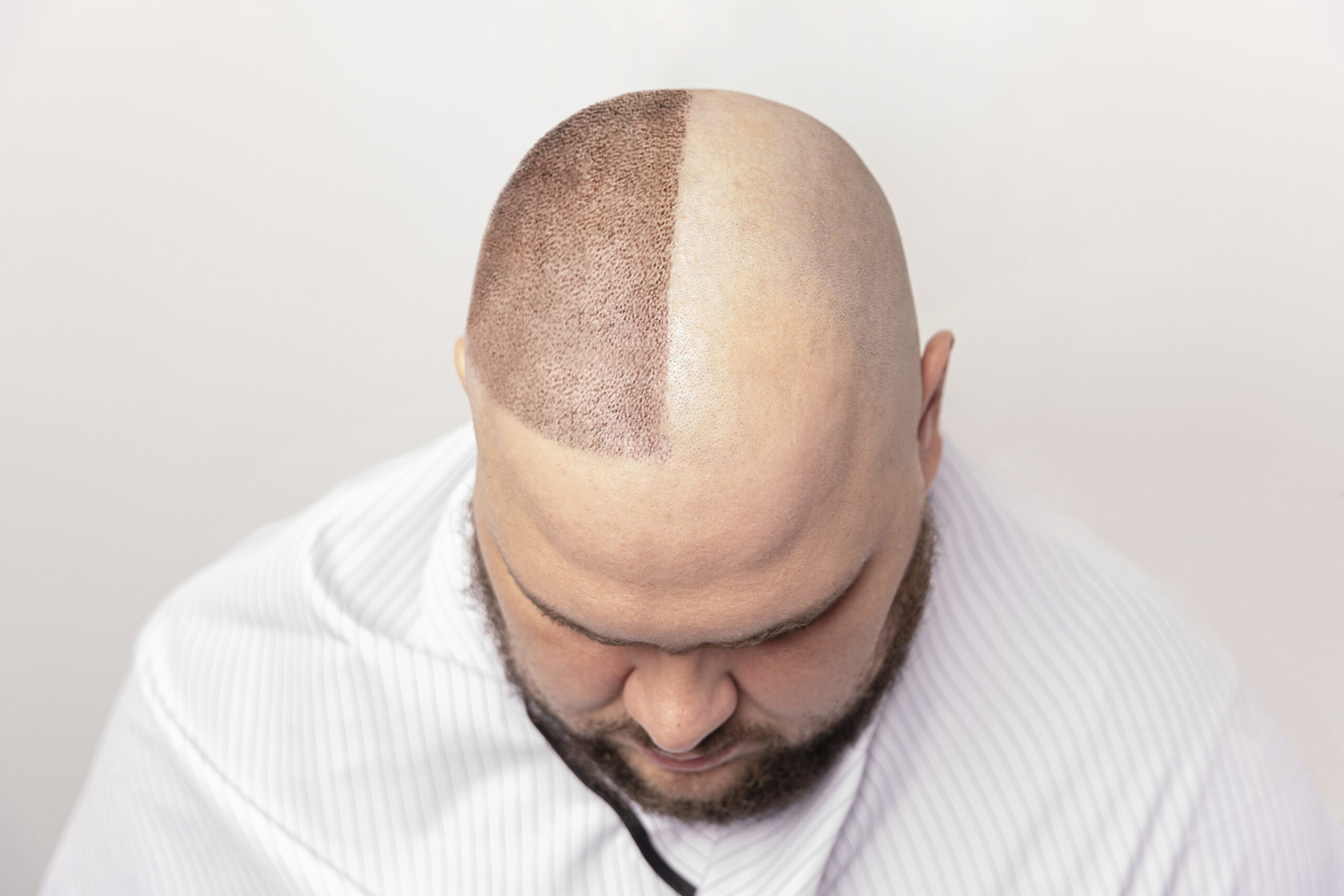 Top-down view of a man's head showing a dramatic scalp micropigmentation (SMP) before-and-after comparison, with one half treated to simulate a shaved head look and the other half untreated.