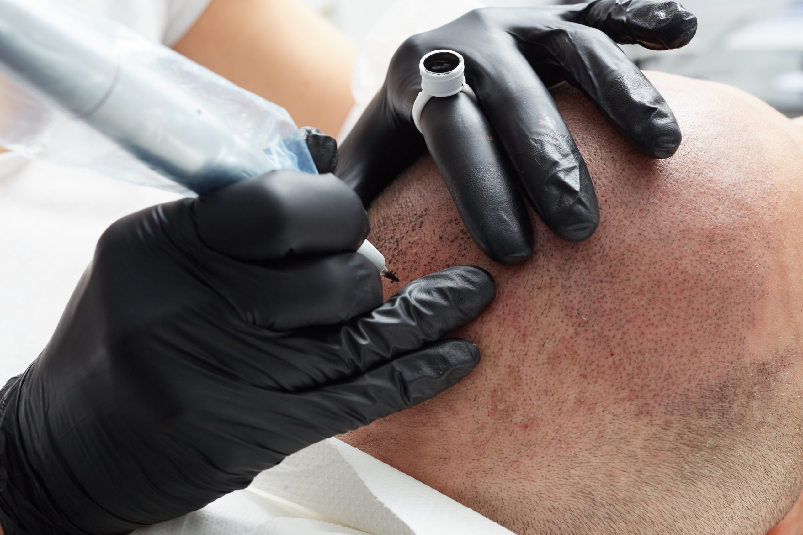 Close-up of a professional in black gloves performing scalp micropigmentation (SMP), simulating hair follicles on a man's bald head using a specialized tattooing device.
