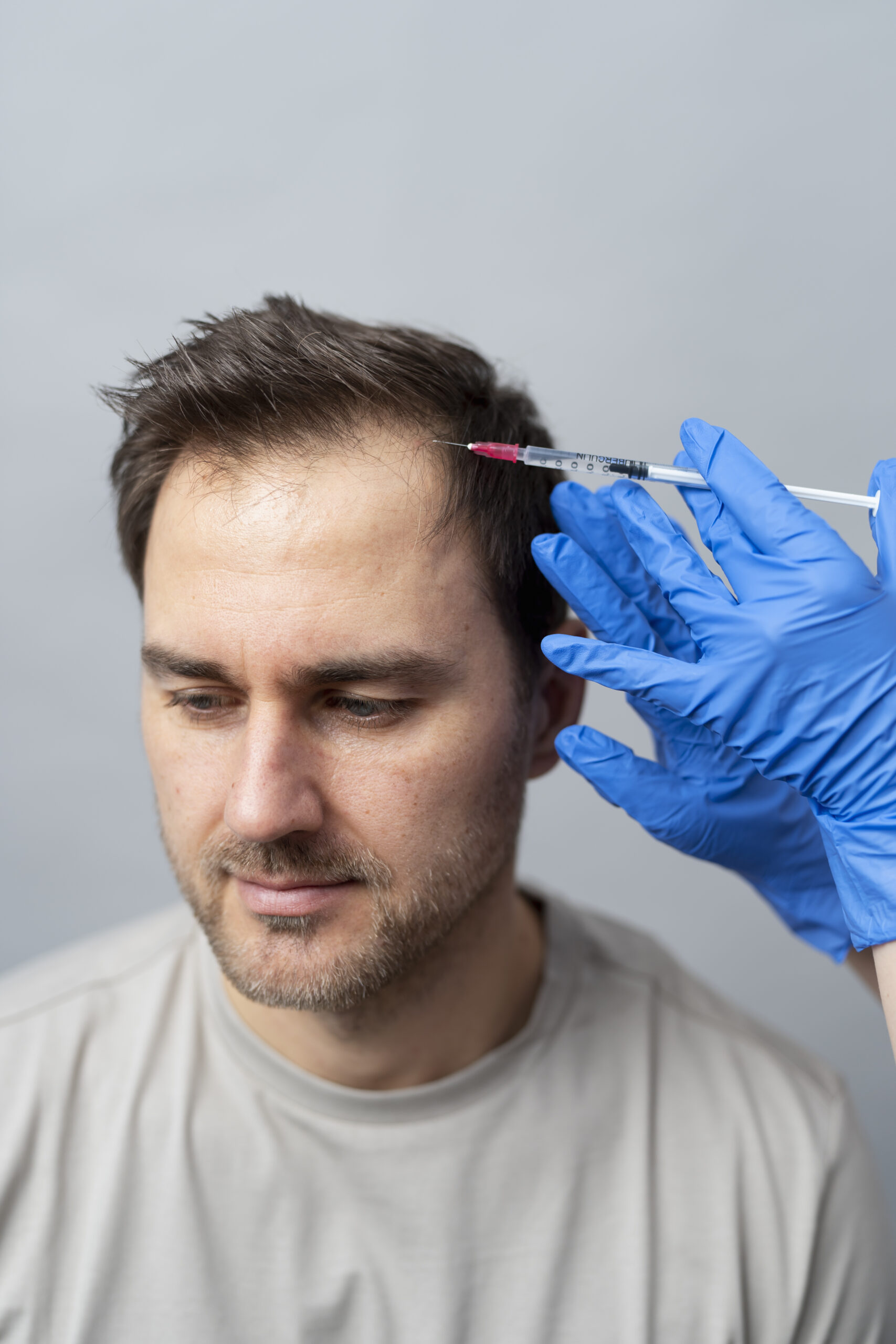 Man receiving a hair restoration injection, such as PRP or Mesotherapy, into his scalp near the hairline from a professional wearing blue gloves.