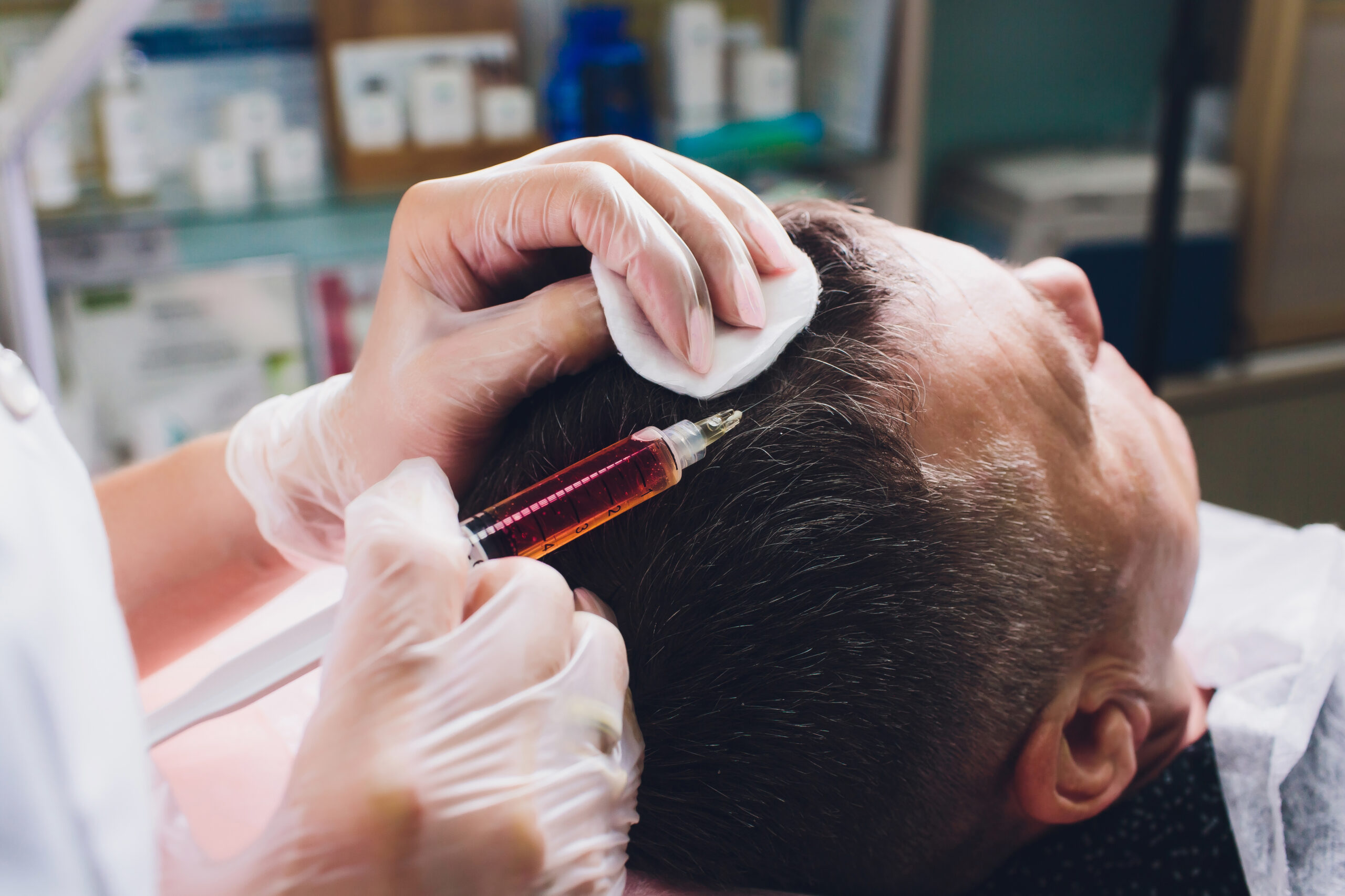 Close-up of a man receiving a Platelet-Rich Plasma (PRP) injection of dark amber fluid into his scalp for hair loss treatment, administered by a professional in clear gloves.