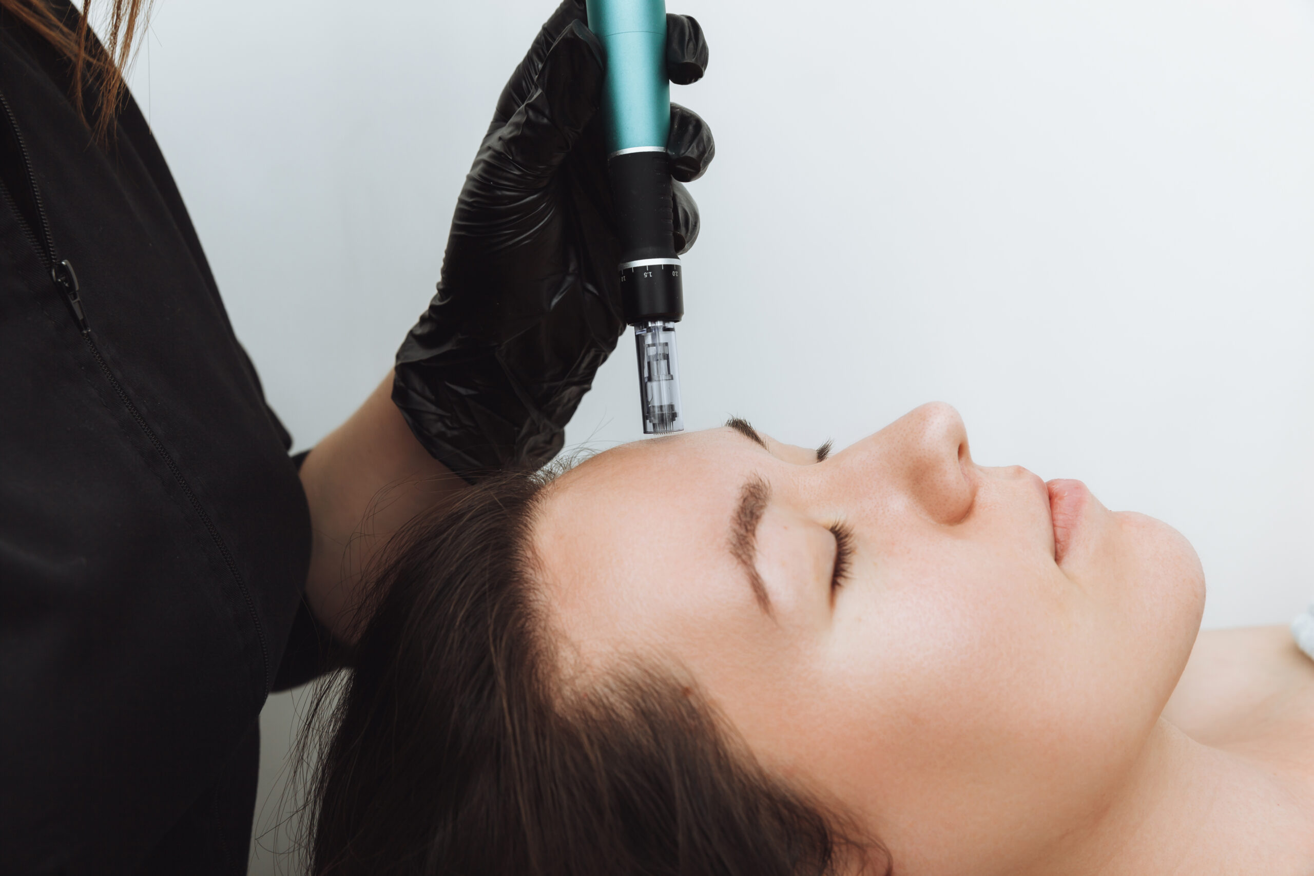 Side profile of a woman receiving a microneedling treatment on her forehead using a motorized pen device held by a professional in black gloves.