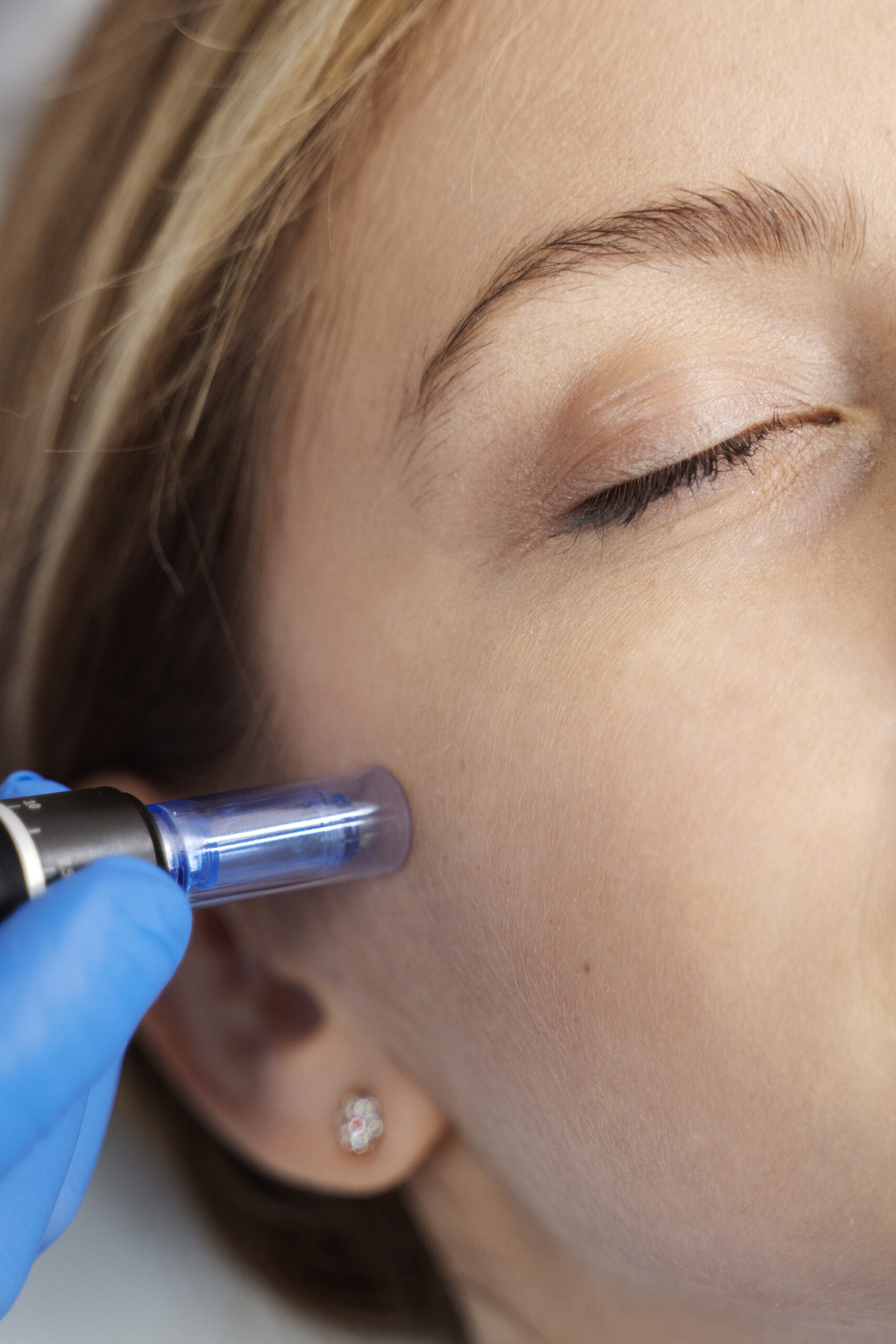 Professional microneedling treatment being performed on a woman's cheek using a motorized dermapen device by a gloved aesthetician.