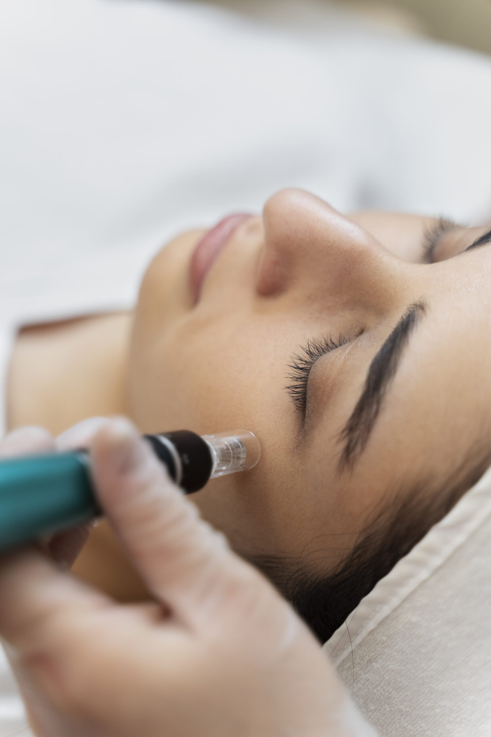 Client receiving a non-invasive skin rejuvenation treatment, likely microneedling, near her cheek and ear, administered by a gloved professional.