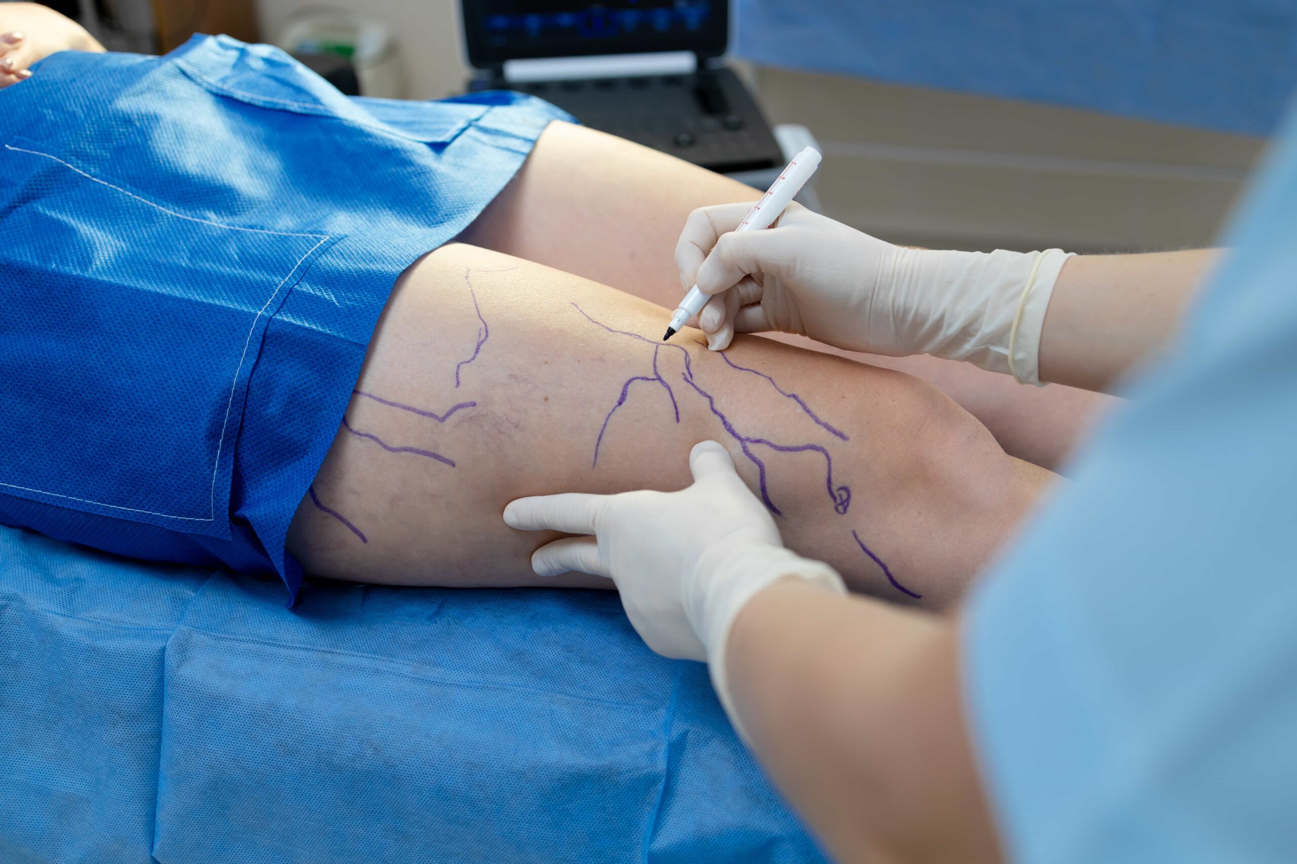 Doctor marking veins on patient leg ready for therapy. 