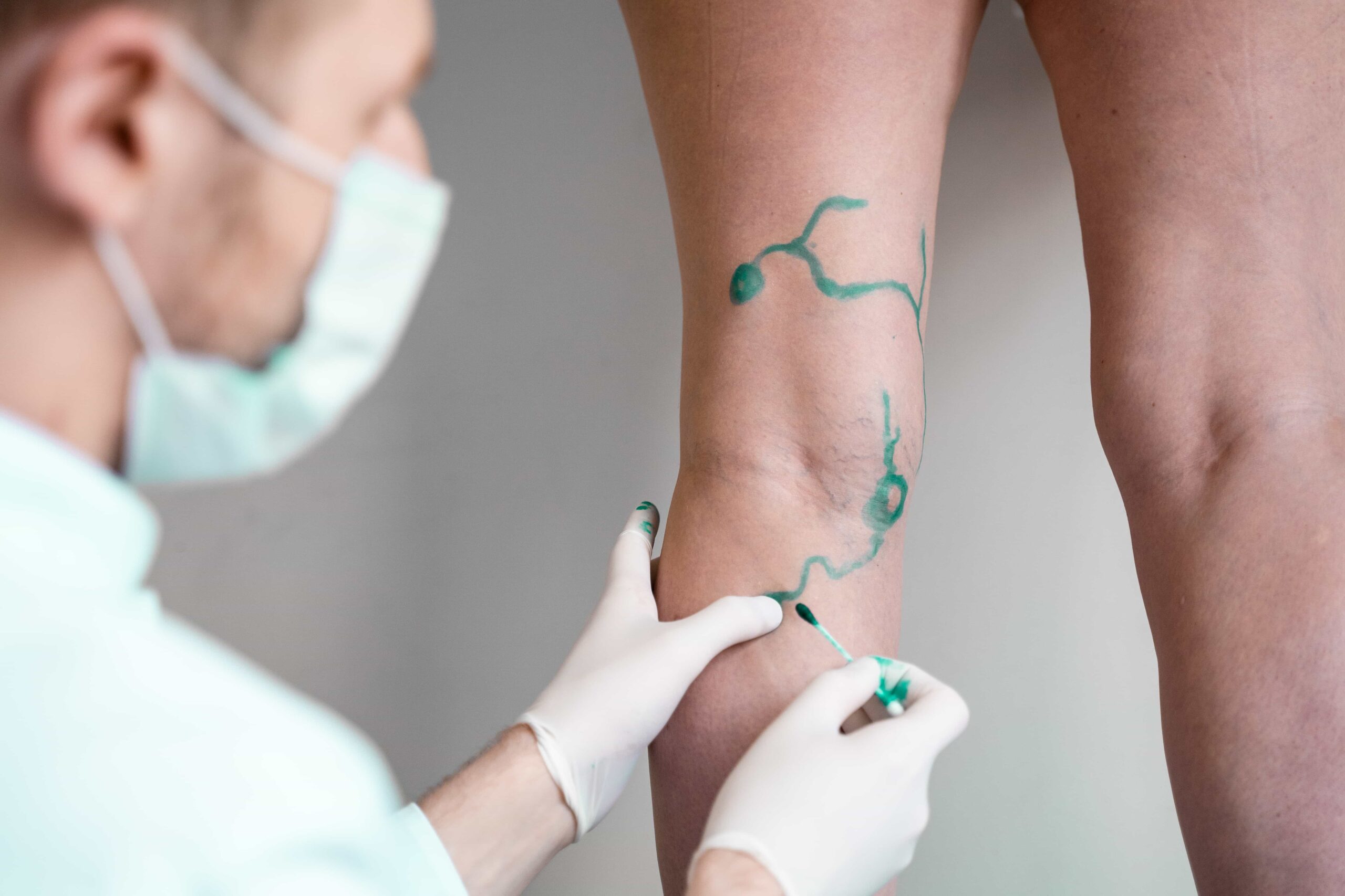 Doctor planning leg vein treatment. 