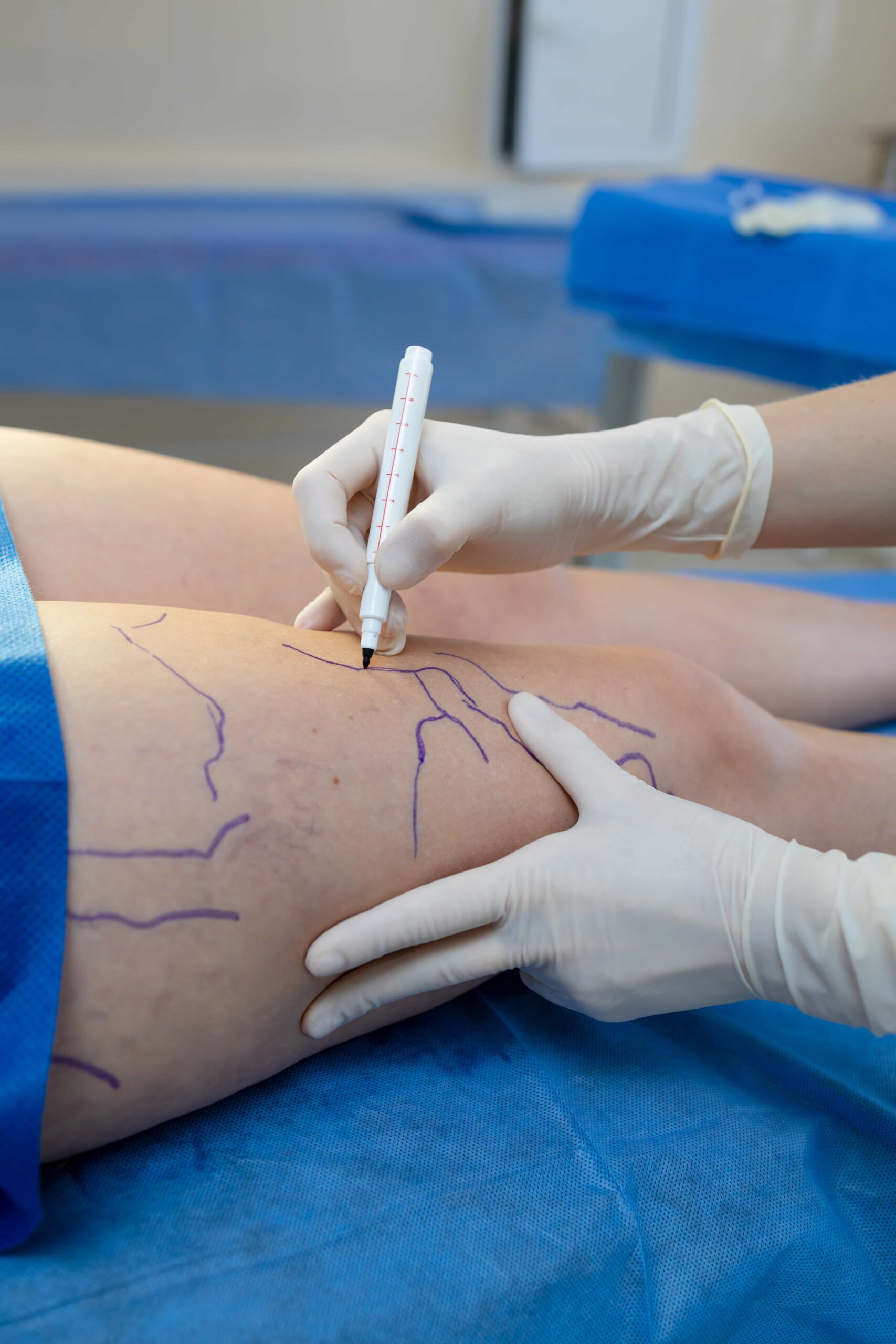 Surgeon drawing map of veins on patient's leg. 