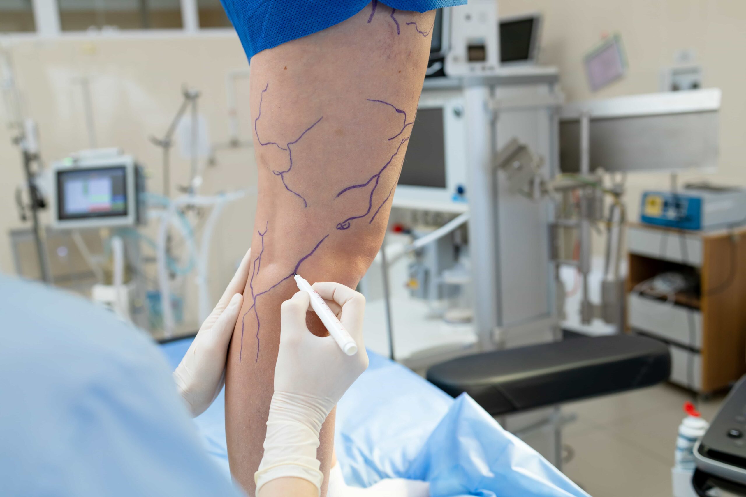 Surgeon planning procedure by drawing map of veins on leg. 